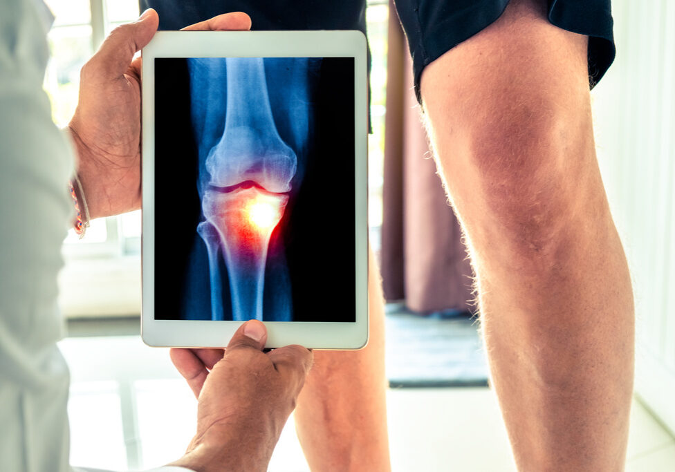 Doctor holding a digital tablet with x-ray of knee of the patient